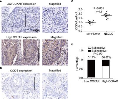 CCKAR is a biomarker for prognosis and asynchronous brain metastasis of non-small cell lung cancer